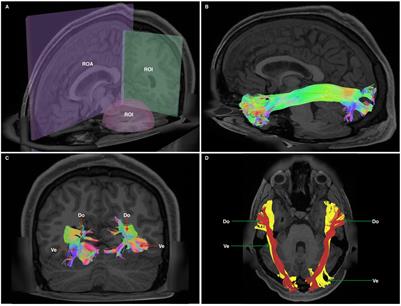 A Quantitative Tractography Study Into the Connectivity, Segmentation and Laterality of the Human Inferior Longitudinal Fasciculus